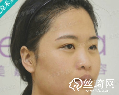 北京禾美嘉醫(yī)療美容自體脂肪填充面部那個醫(yī)生好？