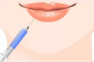玻尿酸豐唇整形手術(shù)注意事項(xiàng) 注射玻尿酸會(huì)腫嗎