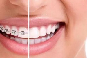 成人做牙齒矯正有危害?牙齒矯正有年齡限制嗎？