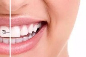 30歲后做牙齒矯正來得及嗎？做正畸會有什么危害？