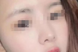 云南瑪麗亞整形美容醫(yī)院做的面部吸脂，原來擁有精致的小臉蛋這么簡單