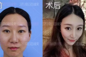 濟(jì)南海峽整形自體脂肪填充：取“脂”于你，用“脂”于你!