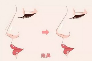 隆鼻假體壽命只有10年?取出后鼻子會變丑?