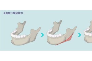 下頷角整形手術要多少錢？下頜角手術后護理注意事項?