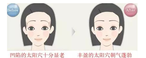 晶馨SG自體脂肪細(xì)胞豐太陽(yáng)穴，秒變V臉女神不是夢(mèng)！