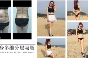 一個(gè)疑思，吸脂減肥真的有用嗎？