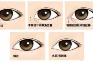 雙眼皮手術要和開眼角手術一起做是什么原因