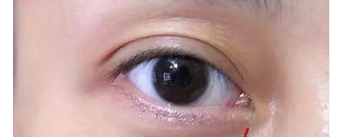 為啥？你做了去眼袋手術(shù)后，又復(fù)發(fā)了呢？