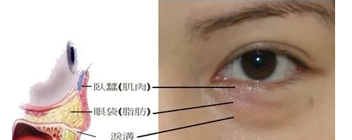 你們可能不知道，淚溝比眼袋丑多了