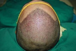 無(wú)錫百年植發(fā)醫(yī)院整形價(jià)格表(價(jià)目表)2020全新發(fā)布