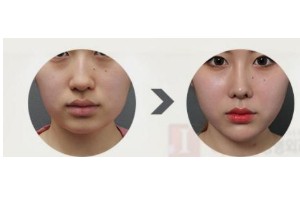 什么是頦部填充術(shù)，如何快速消腫