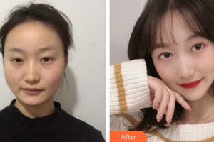 滄州瑞美醫(yī)療美容門(mén)診部張鵬整形價(jià)格表附下頜角手術(shù)案例展示