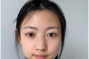 昆明吳氏嘉美美容醫(yī)院李明整形價格表附鼻修復案例展示