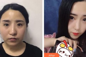 上海解放軍第四五五醫(yī)院激光整形科黃佰乾麻醉科副主任 整形價格表附眼部手術案例展示