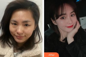 成都美立方（原華博）醫(yī)療美容醫(yī)院張娟整形價(jià)格表附眼部綜合案例展示