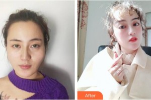 成都春天醫(yī)療美容門(mén)診部廖建春整形價(jià)格表附面部輪廓案例展示