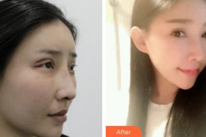 廣州廣美整形美容醫(yī)院伍新鵬整形價格表附雙眼皮修復(fù)案例展示