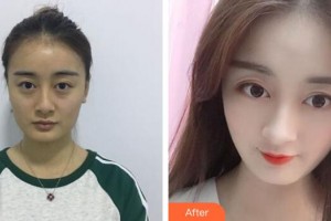 廣州星團(tuán)醫(yī)學(xué)美容門(mén)診部劉明整形價(jià)格表附假體隆鼻案例展示