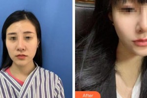廣州美萊醫(yī)療美容醫(yī)院彭靜整形價(jià)格表附多方面部埋線(xiàn)提升案例展示