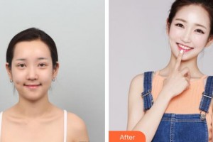 上海宏康醫(yī)院整形美容中心宋東明整形價(jià)格表附	鼻部手術(shù)整形案例展示