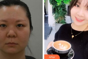 廣州美恩整形美容醫(yī)院陳曉整形價(jià)格表附多方面部埋線提升案例展示