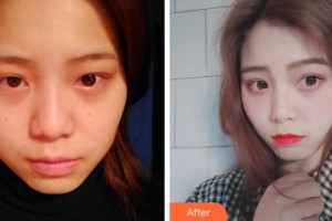 上海德琳醫(yī)療美容醫(yī)院付瑾整形價格表附光子嫩膚案例展示