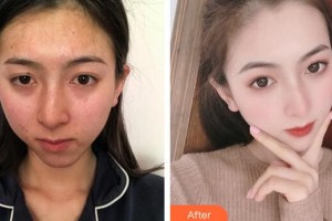 廣州新時(shí)代整形美容醫(yī)院饒曉艷美容皮膚醫(yī)師 咨詢(xún)培訓(xùn)師整形價(jià)格表附健康素顏肌案例展示