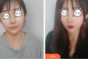 上海麗人整形美容醫(yī)院崔潔整形價(jià)格表附無針?biāo)獍咐故?>
</a>
<h3 class=