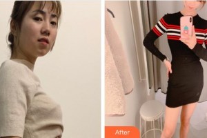 上?？祳W醫(yī)療美容醫(yī)院何玉成整形價(jià)格表附光子套餐案例展示
