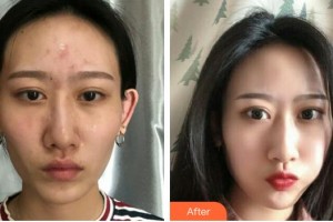 上?？祳W醫(yī)療美容醫(yī)院袁智娟整形價(jià)格表附激光去紅血絲案例展示
