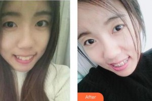沈陽(yáng)杏林整形美容醫(yī)院朱石江整形價(jià)格表附牙齒矯正案例展示