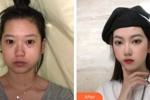 廣州華美醫(yī)療美容醫(yī)院李春滿(mǎn)整形價(jià)格表附下頜角磨骨案例展示