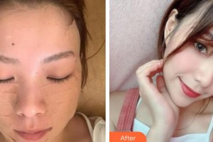廣州時(shí)光整形美容醫(yī)院宋靜整形價(jià)格表附埋線提升案例展示