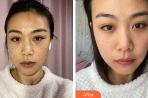 上海宏康醫(yī)院整形美容中心李愛濤整形價(jià)格表附祛斑日記案例展示