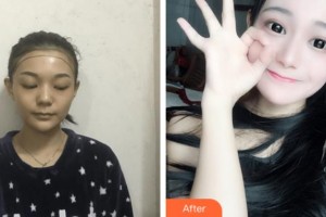 上海宏康醫(yī)院整形美容中心張會(huì)堂 教授整形價(jià)格表附種植發(fā)際線案例展示