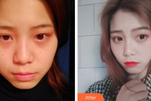 廣州時(shí)光整形美容醫(yī)院阿曼博士整形價(jià)格表附激光美膚激光案例展示