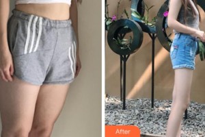上海華美美萊美容醫(yī)院夏國興整形價(jià)格表附大腿吸脂案例展示