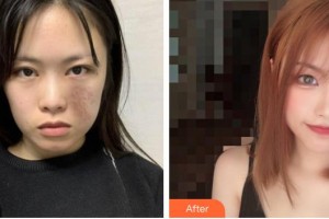 上海宸妃醫(yī)學美容醫(yī)院徐永成整形價格表附燙傷疤痕案例展示