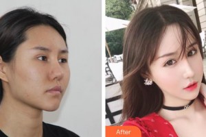 上海伊美爾港華醫(yī)療美容醫(yī)院巴希尓·阿特馬尼整形價格表附頜面整形案例展示