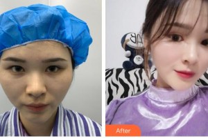 上海時光整形外科醫(yī)院李靜林整形價格表附鼻部手術案例展示