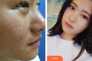 上海鵬愛醫(yī)療美容門診部李惠娟整形價格表附點陣激光祛痘案例展示