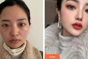 上海鵬愛醫(yī)療美容門診部秦玉良整形價格表附射頻溶脂瘦臉案例展示