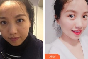 上海美爾雅醫(yī)療美容醫(yī)院劉麒整形價格表附巨補水祛除暗沉淡化眼紋案例展示