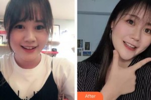 上海百達麗醫(yī)療美容醫(yī)院林曉松整形價格表附金屬托槽矯正案例展示