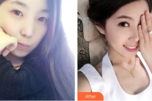 上海原辰醫(yī)療美容醫(yī)院王博整形價格表附牙齒隱形矯正案例展示