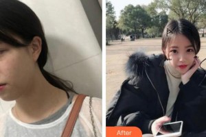 上海華美整形美容醫(yī)院李恩生整形價格表附超激光美膚激光案例展示