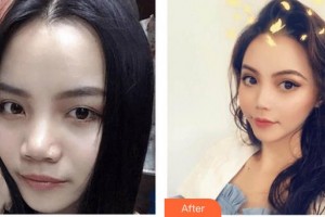 上海保加醫(yī)療美容門診部楊勇整形價(jià)格表附硅膠鼻部手術(shù)案例展示