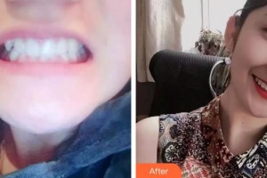 上海薇凱醫(yī)療美容門診部張毅整形價(jià)格表附牙齒做美容案例展示