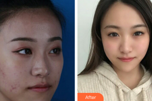 廣州華美醫(yī)療美容醫(yī)院胡艷霞整形價(jià)格表附果酸煥膚案例展示
