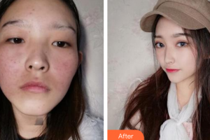 廣州利美康粵美醫(yī)療美容門(mén)診部龔麗珍美容科激光師整形價(jià)格表附皮膚管理案例展示